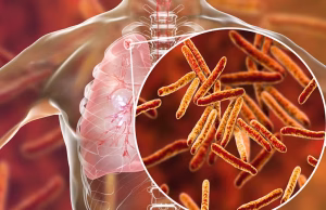 Lutte contre la tuberculose au Cameroun : Chassé-croisé au chevet des malades